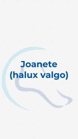 Joanete (halux valgo)